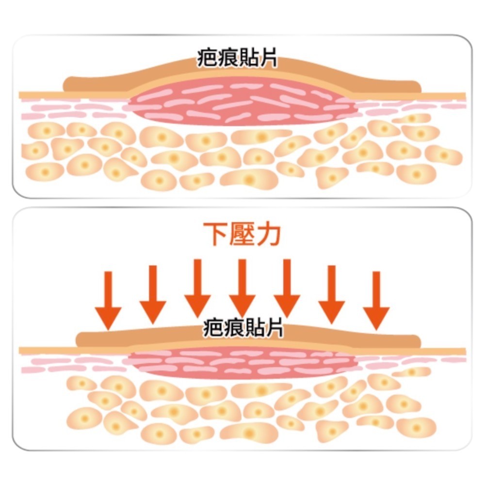 【喜能膚】疤痕貼片 5片/盒 兩種尺寸 醫療級感壓膠 獨特專利結構 舒適服貼